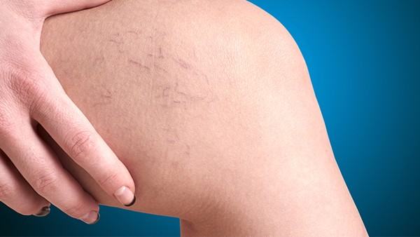 淋巴瘤的免疫抑制治疗