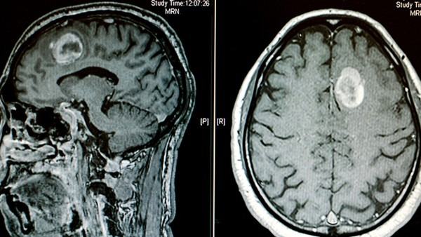 滴虫性阴道炎治疗期间如何缓解不适？