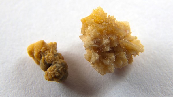 溃疡性结肠炎和结肠癌的关系