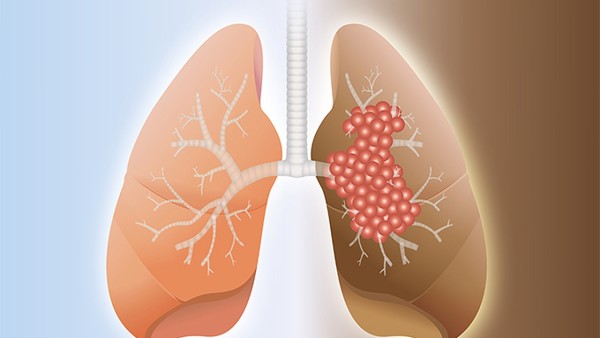 胰腺内分泌肿瘤患者的心理疏导