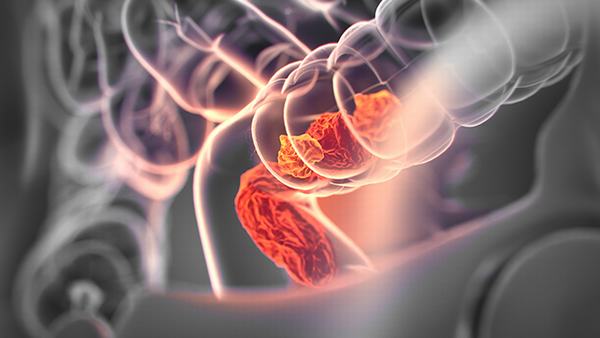 湿热病是否需要手术治疗