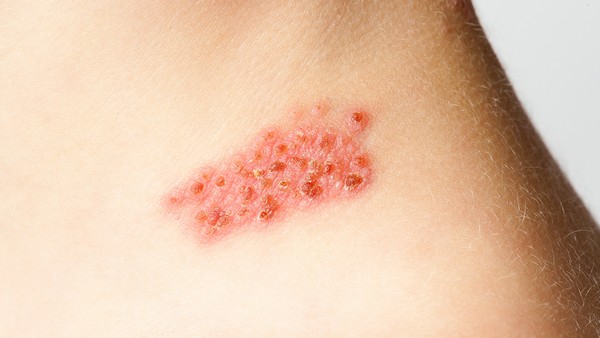 急性肺水肿的自我护理方法