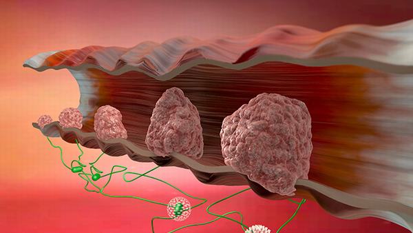 骨髓纤维化的夜间出汗