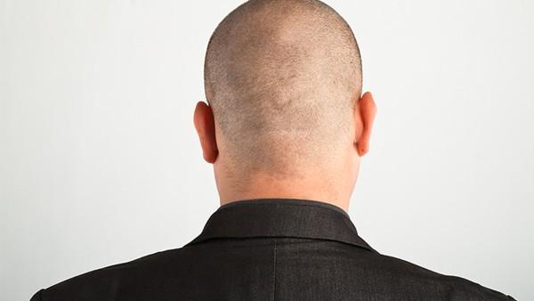 基底细胞癌的免疫抑制治疗