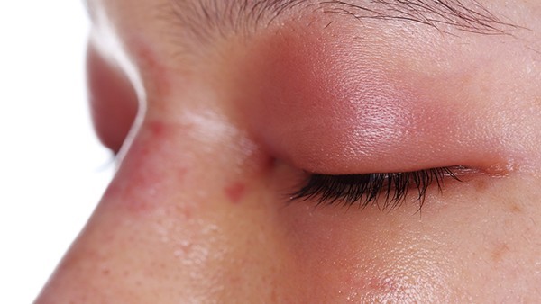 苔藓样念珠状疹的饮食调理方法