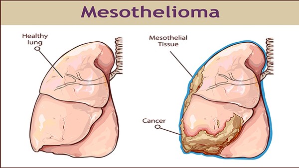 慢阻肺能做手术治疗吗