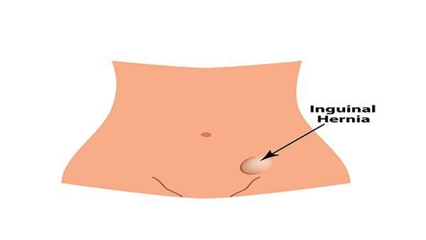 头颈肿瘤的复发原因