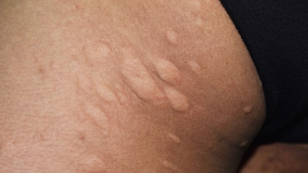 胆管结石要做哪些检查