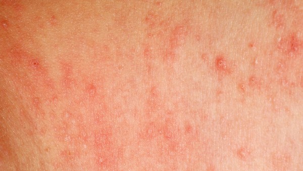 输卵管癌的化疗效果