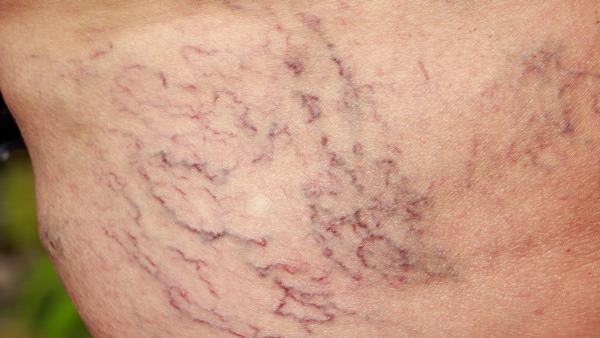 肝小静脉闭塞病的遗传易感性