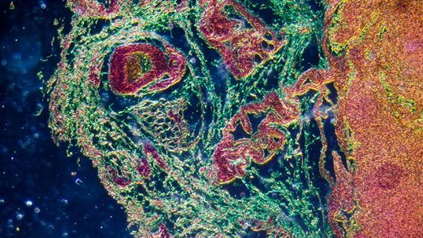 胃肠胰内分泌肿瘤的抗肿瘤药物