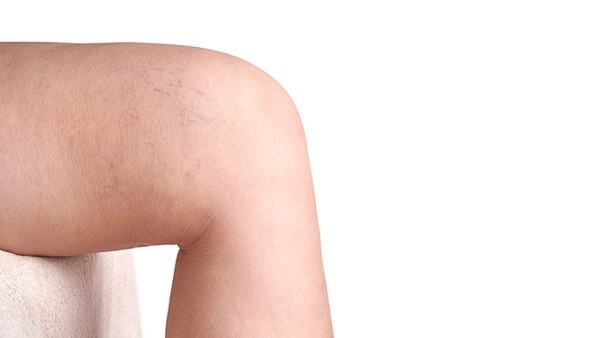 睾丸癌的诊断流程