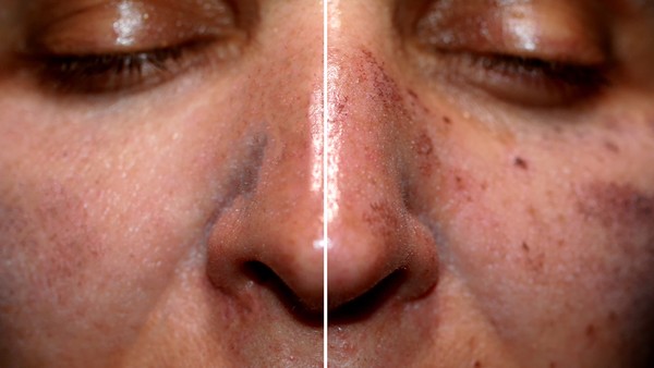 硬下疳的免疫治疗方法