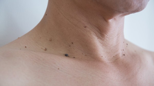 肾结石会影响怀孕吗