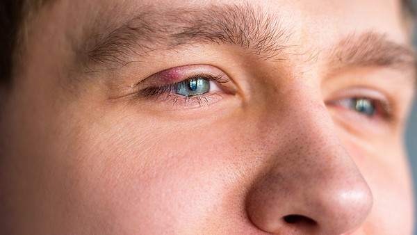 痤疮疤痕能完全去除吗？