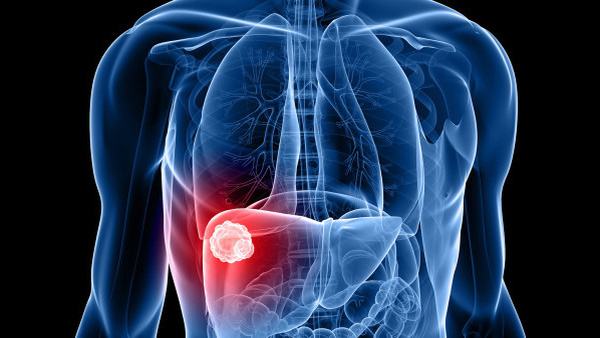 狼疮性肾炎是否会导致肾功能衰竭