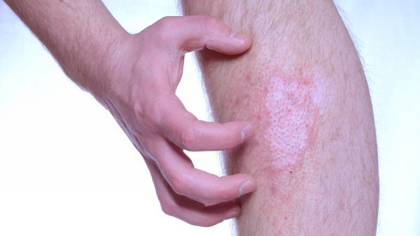 运动能缓解肠绞痛吗