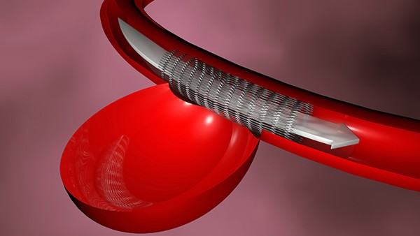 肾结石怎么通过药物治疗