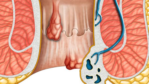 胸膜炎患者的长期随访计划