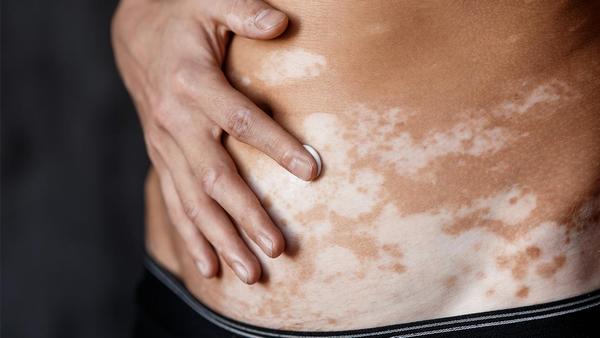 反流性食管炎会导致胃酸过多吗