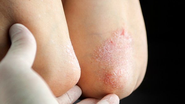 库欣综合征的护理要点