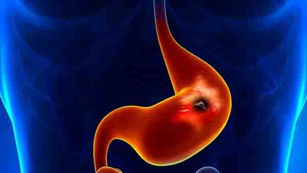 合胞病毒感染的肺部X光检查