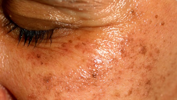 反流性食管炎疼痛怎么办