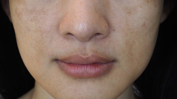 甲状腺眼病是否会影响眼部视觉